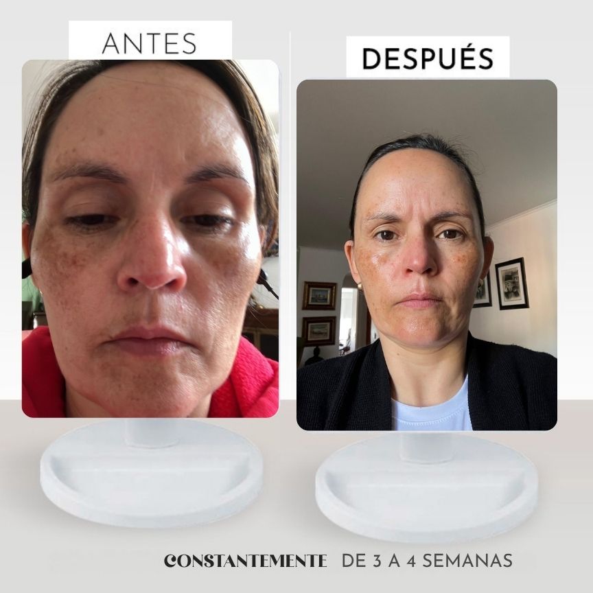 Kit Despigmentante manchas profundas